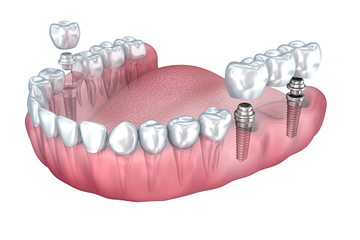 Image of jaw with single dental implant screw and bridge from Roy C. Blake III, DDS, MSD, Maxillofacial Prosthodontist in Jupiter FL