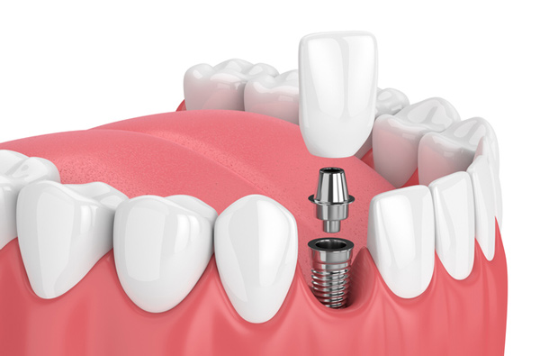 Rendering of jaw with dental implant from Roy C. Blake III, DDS, MSD, Maxillofacial Prosthodontist in Jupiter, FL